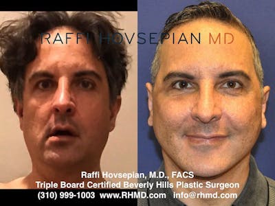 Procedures Before & After Gallery - Patient 74399897 - Image 1