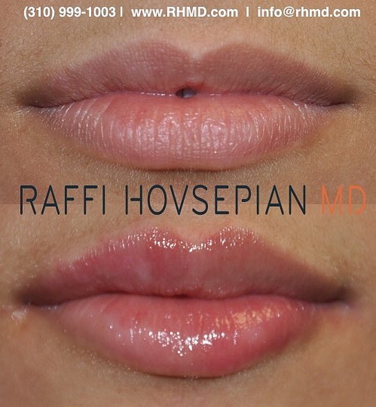 patient before and after lip augmentation 1
