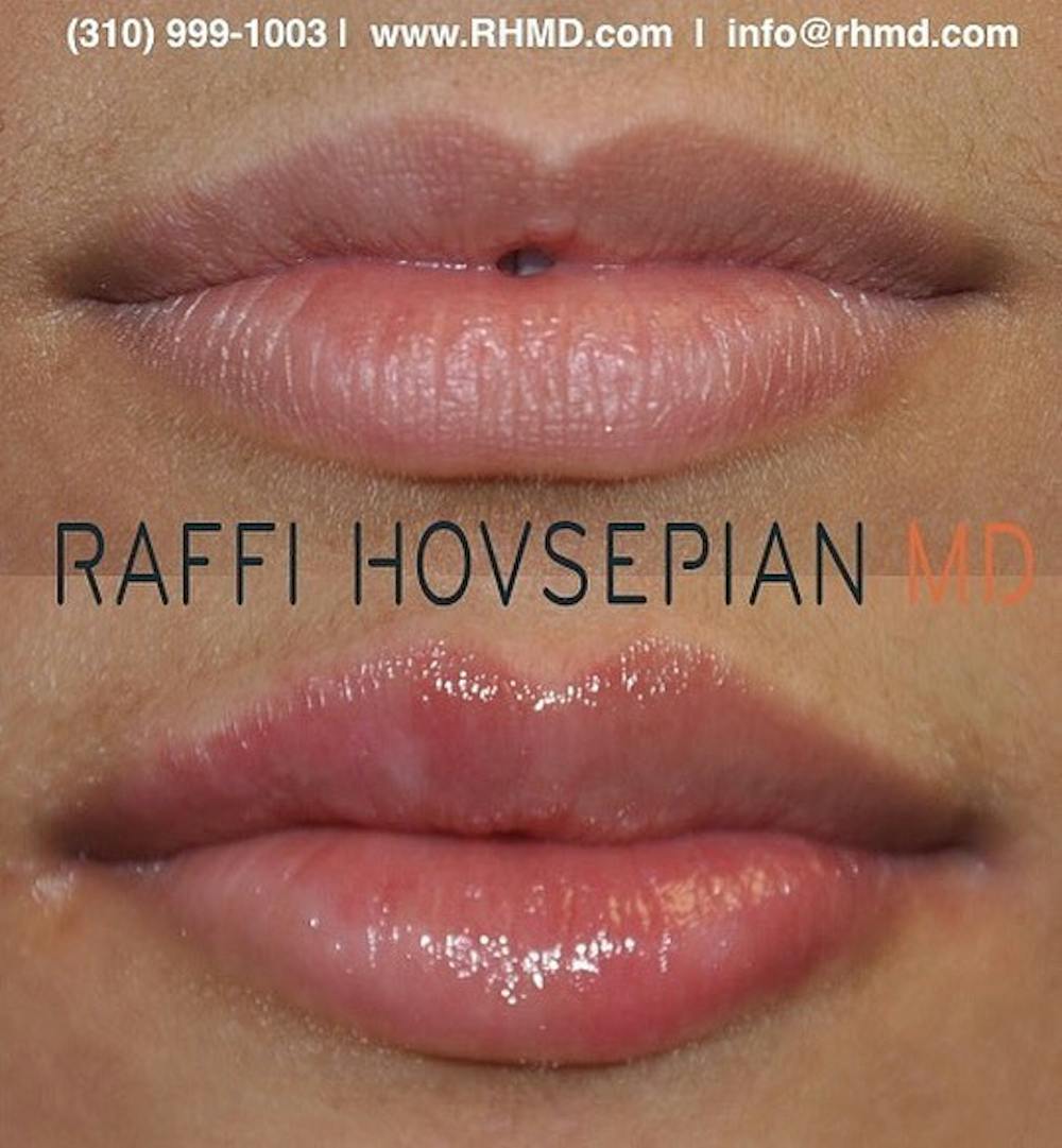patient before and after lip augmentation 1