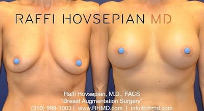 breast augmentation before and after front view 1