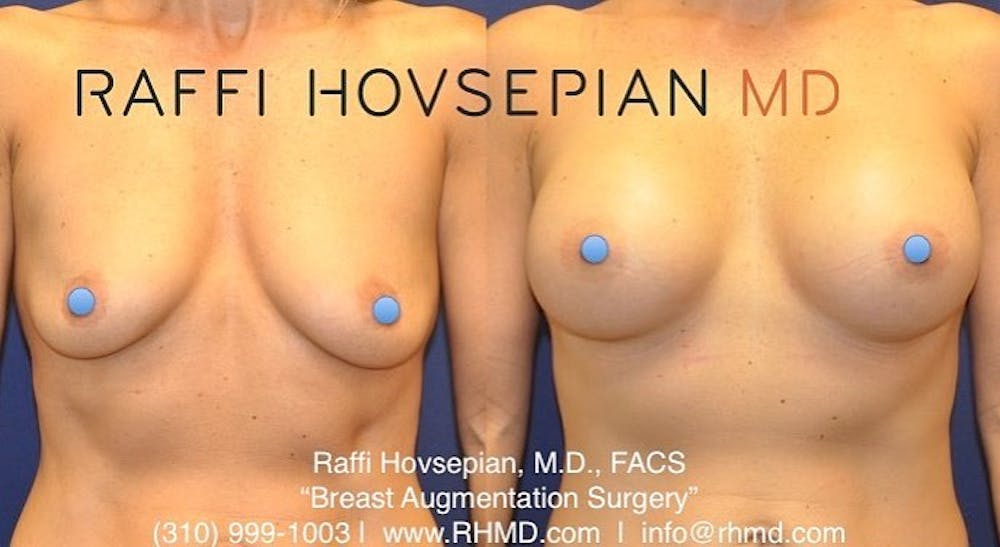 breast augmentation before and after front view 1