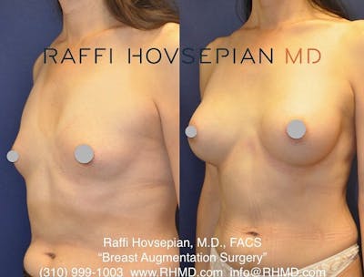 Procedures (old) Before & After Gallery - Patient 74399915 - Image 1