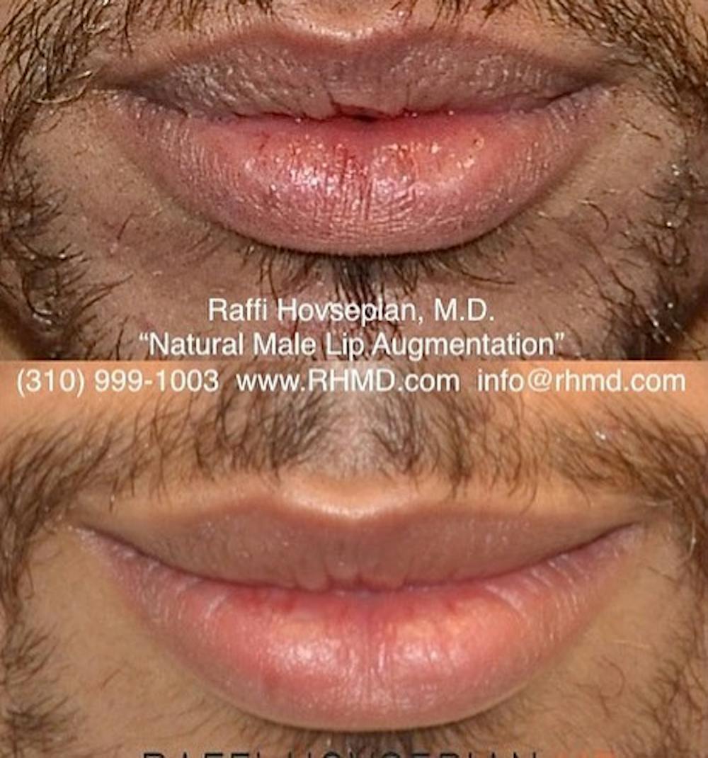 Procedures Before & After Gallery - Patient 74399922 - Image 1