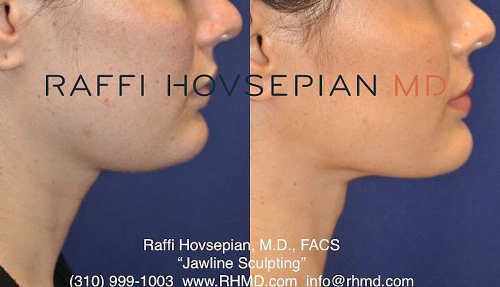 Procedures Before & After Gallery - Patient 351693 - Image 1