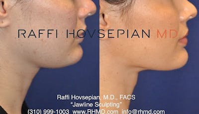 Procedures Before & After Gallery - Patient 351693 - Image 1