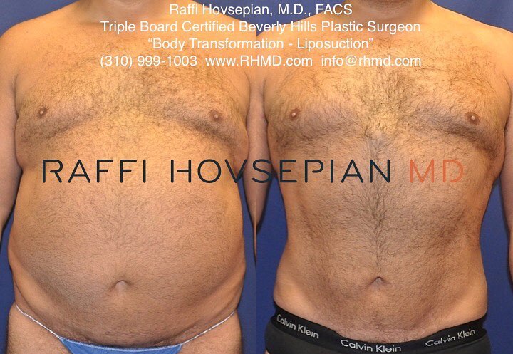 male before and after liposuction