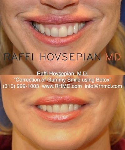 Procedures Before & After Gallery - Patient 189892995 - Image 1