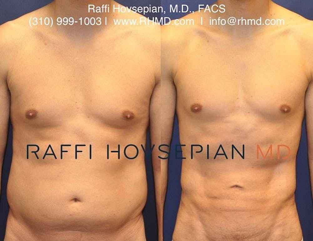 male before and after liposuction