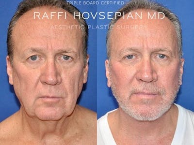 Procedures (old) Before & After Gallery - Patient 144405265 - Image 1