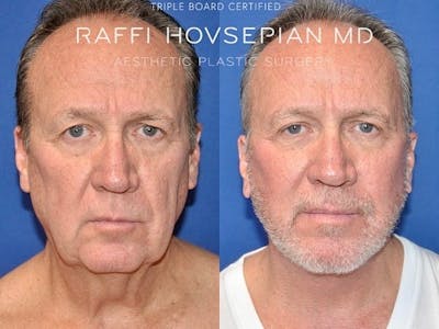 Procedures Before & After Gallery - Patient 144405265 - Image 1