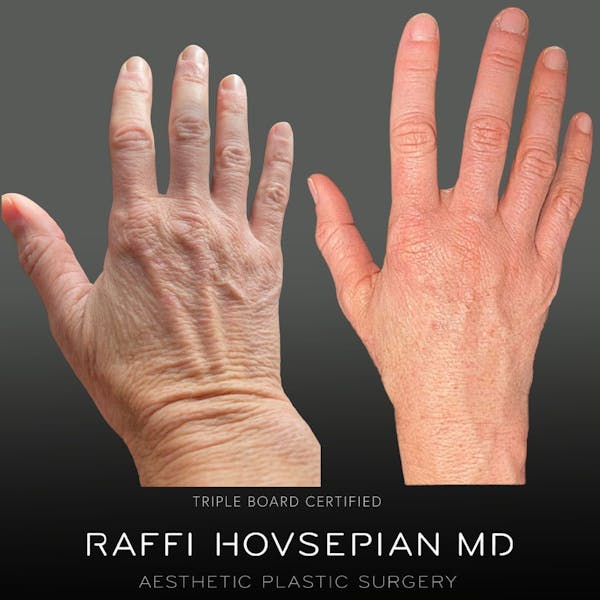 Hand Rejuvenation