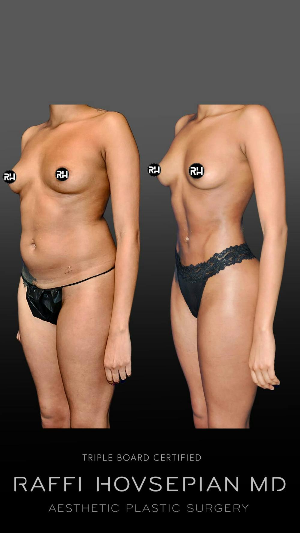 Procedures Before & After Gallery - Patient 163170948 - Image 1
