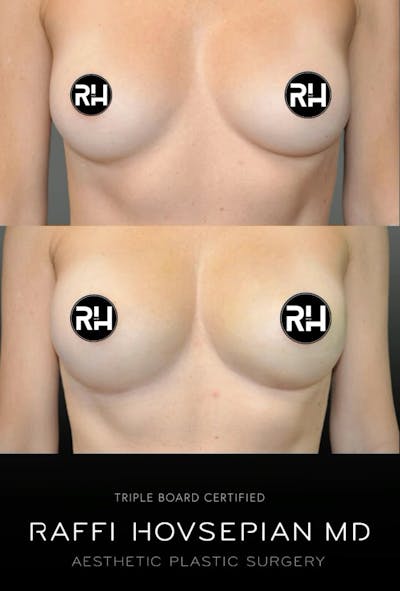 Procedures (old) Before & After Gallery - Patient 179506499 - Image 1