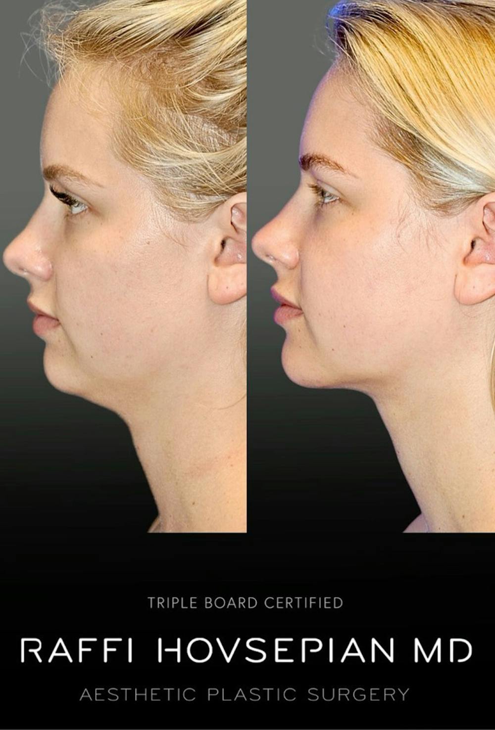 Procedures (old) Before & After Gallery - Patient 179506539 - Image 1