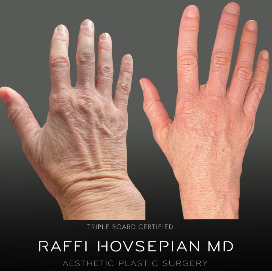 before and after of hand rejuvenation