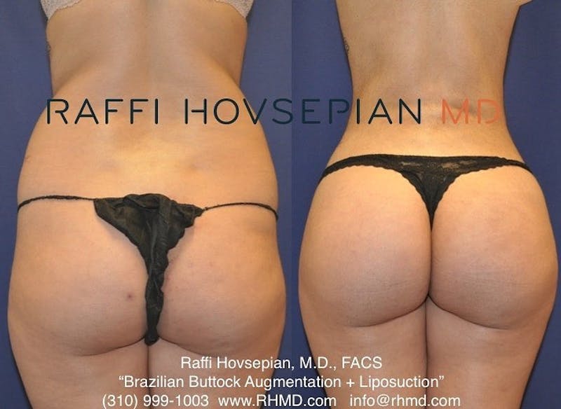 Brazilian Butt Lift - Spokane Liposuction Specialty Clinic