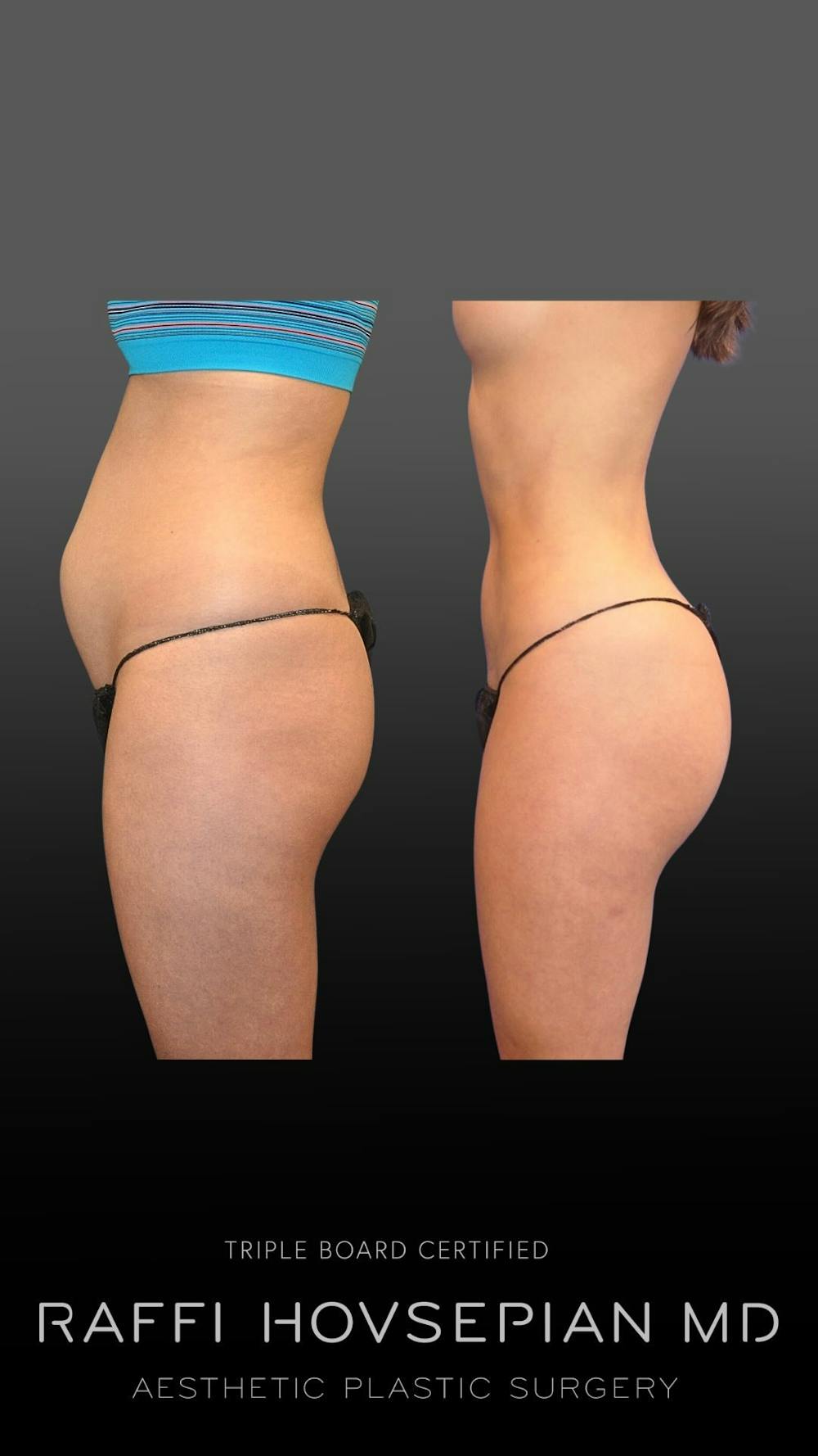 Procedures Before & After Gallery - Patient 150278 - Image 1