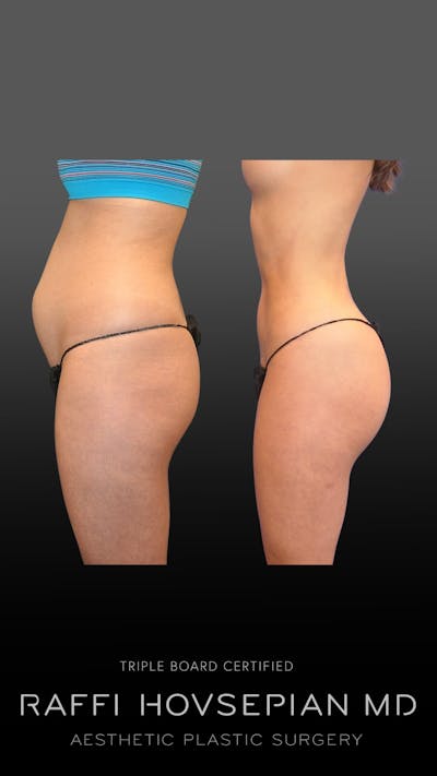 Procedures Before & After Gallery - Patient 150278 - Image 1
