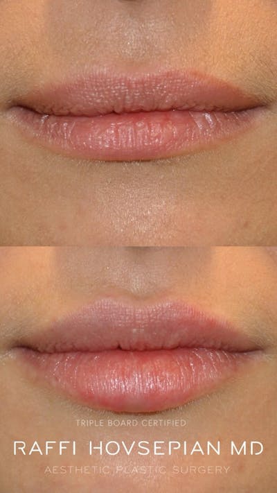 Procedures Before & After Gallery - Patient 398701 - Image 1