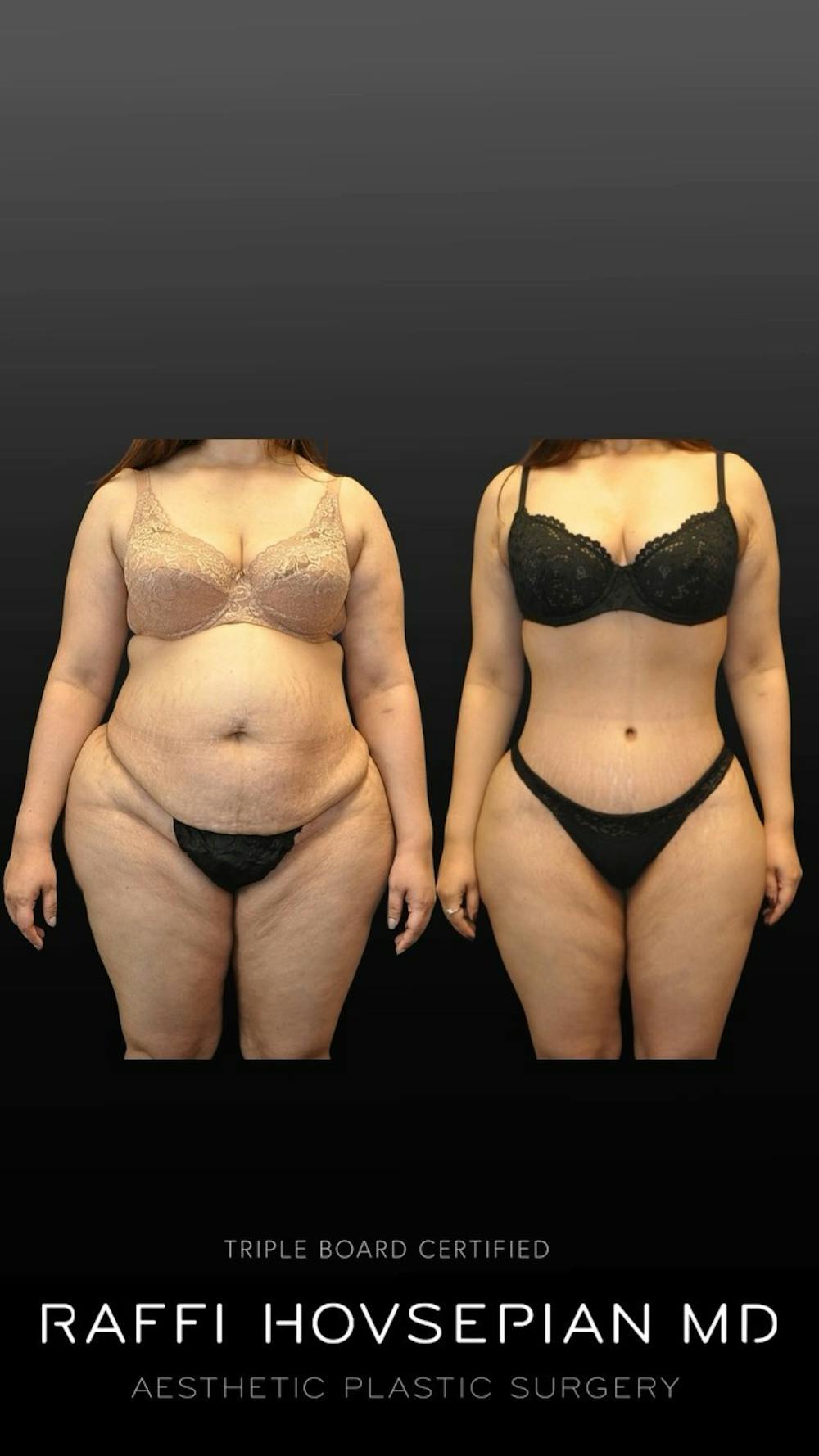 before and after a mommy makeover