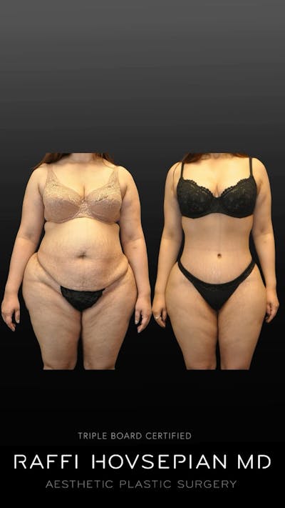 before and after a mommy makeover