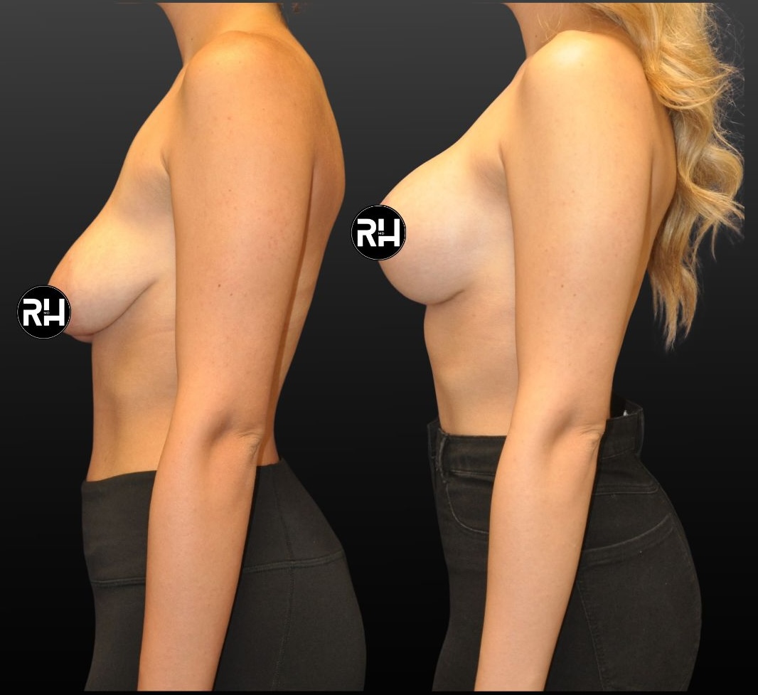 Raffi Hovsepian, MD Blog |  Breast Lift Vs. Breast Augmentation: Which is Right For Me?