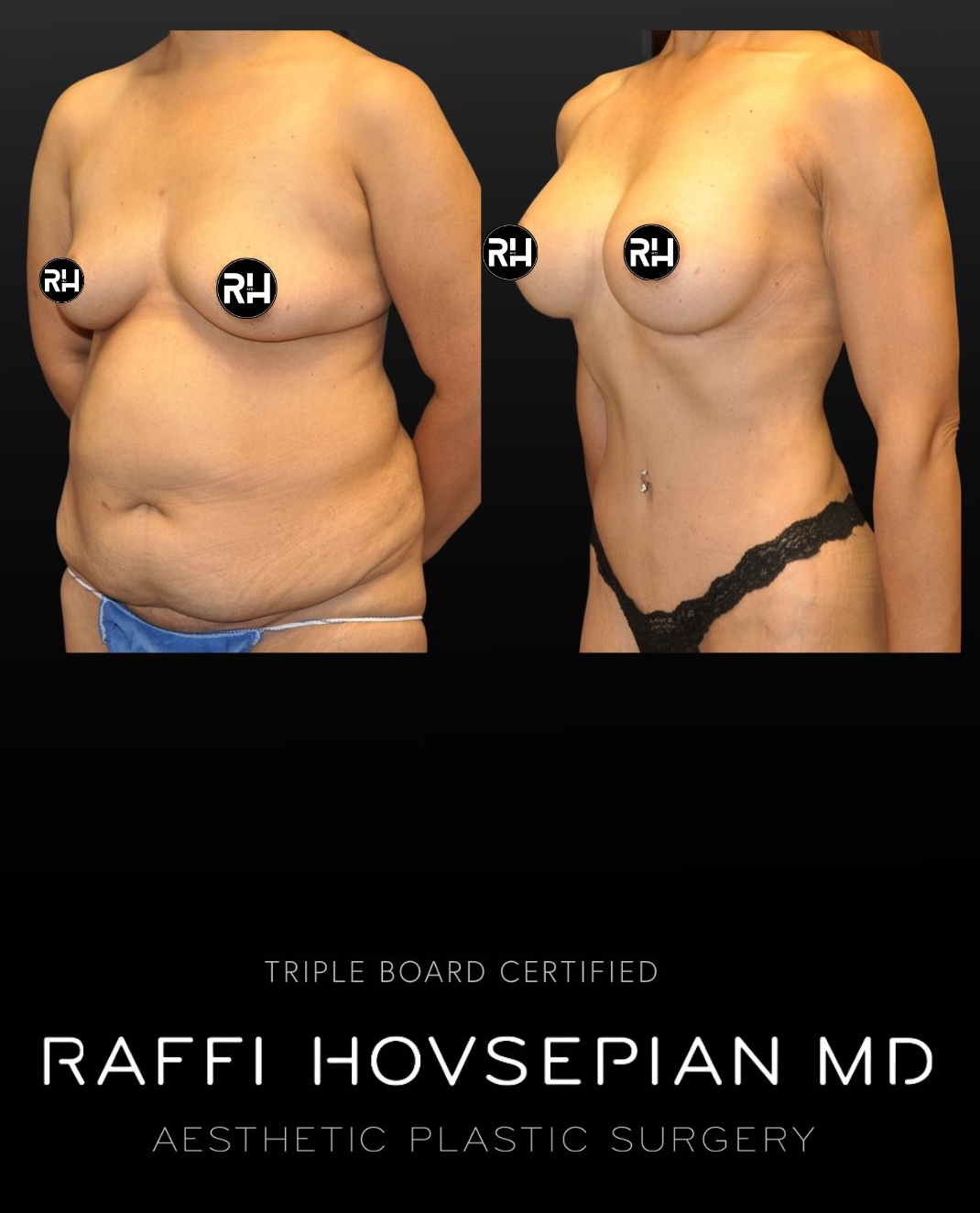 Raffi Hovsepian, MD Blog | Mini Tummy Tuck or Full Tummy Tuck - Which is Best?