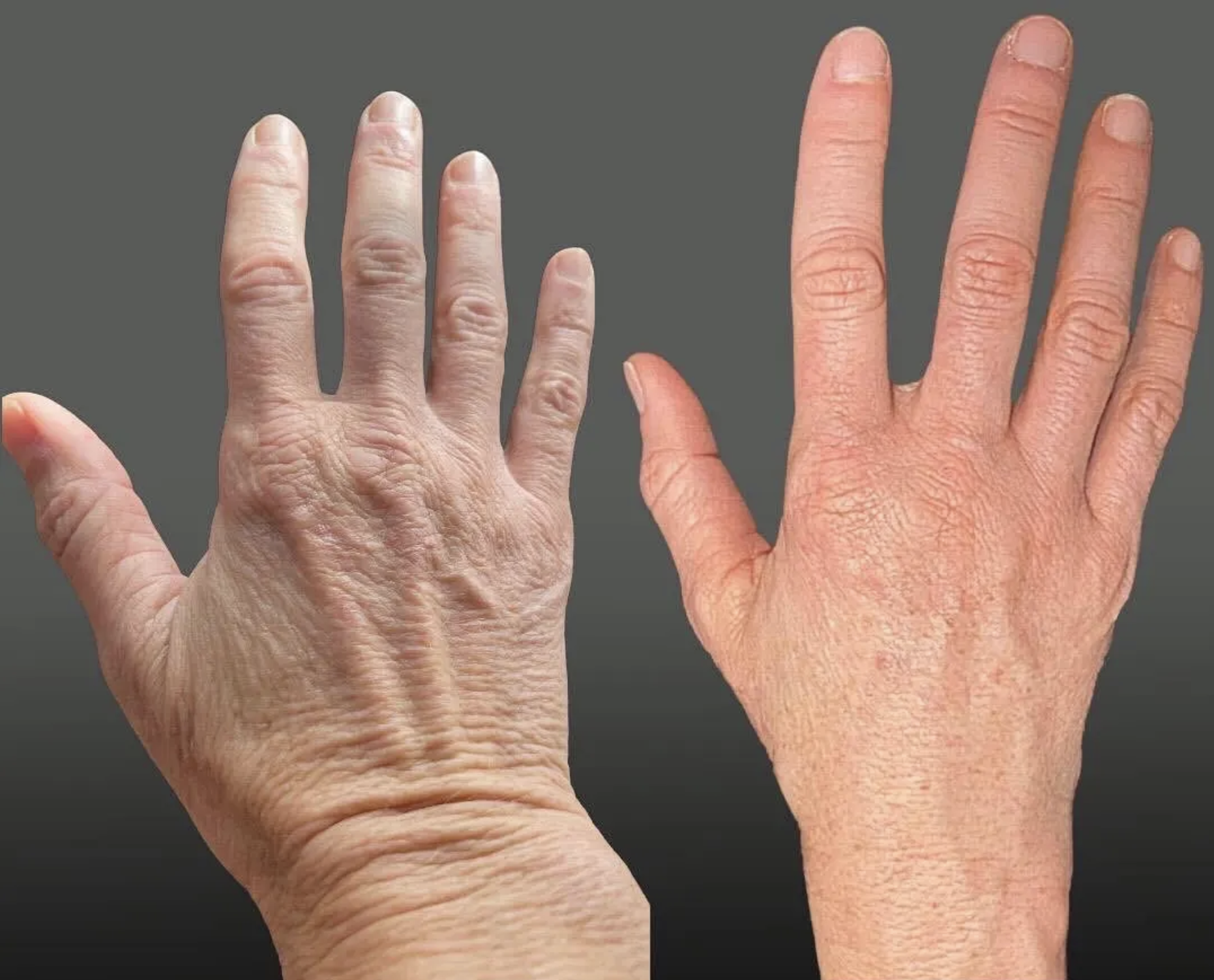 Raffi Hovsepian, MD Blog | Achieve Youthful Hands with Dr. Raffi Hovsepian