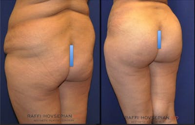 Procedures Before & After Gallery - Patient 189892969 - Image 1