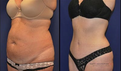 Procedures Before & After Gallery - Patient 552791 - Image 1