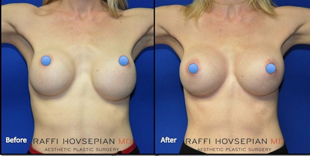 Procedures Before & After Gallery - Patient 501809 - Image 1