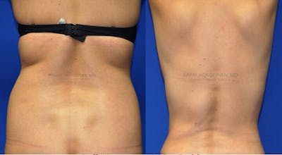 Procedures Before & After Gallery - Patient 106842 - Image 1