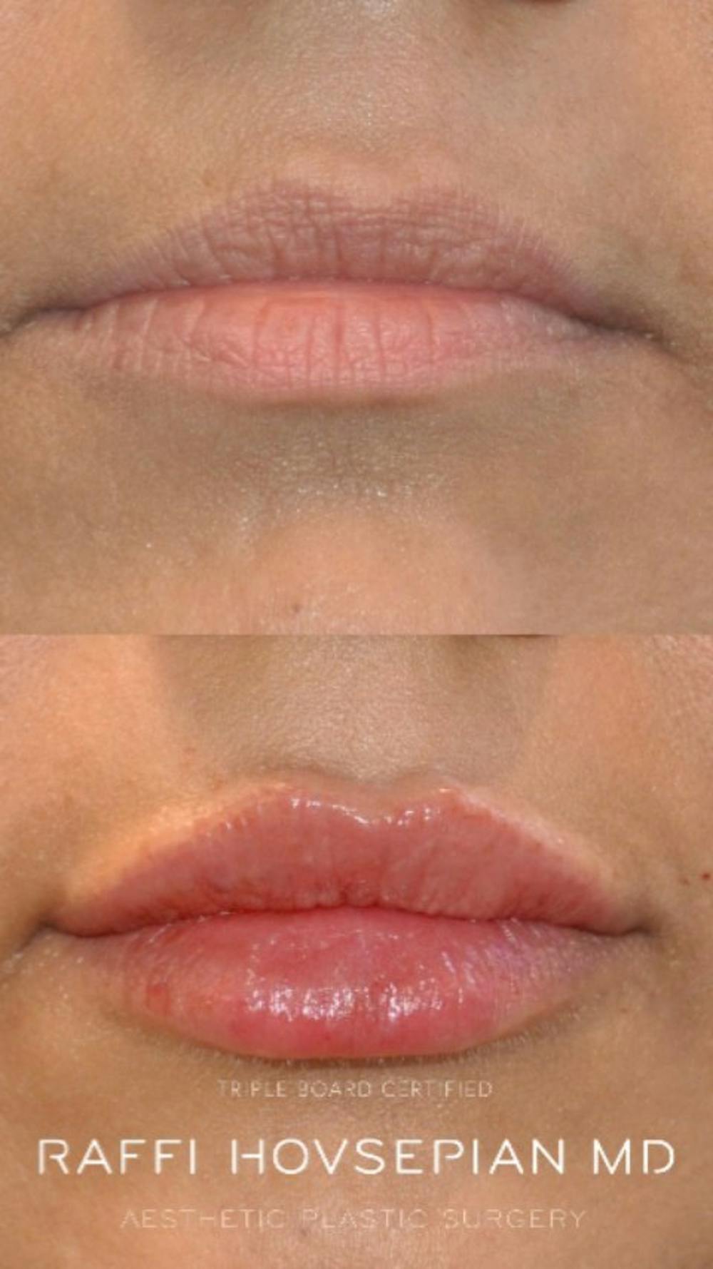 Procedures Before & After Gallery - Patient 585730 - Image 1
