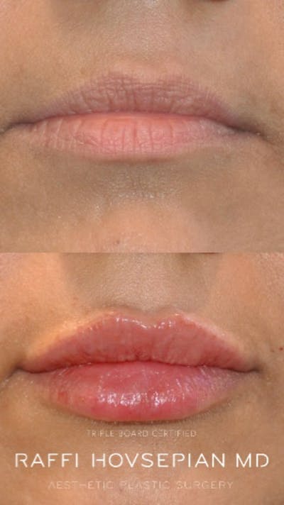Procedures Before & After Gallery - Patient 585730 - Image 1
