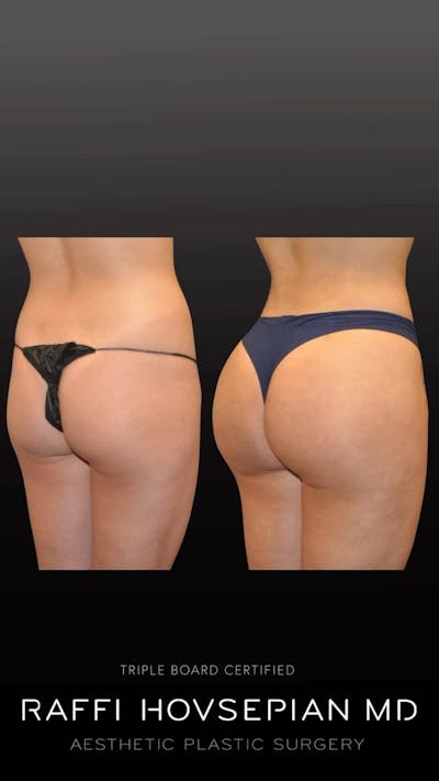Procedures Before & After Gallery - Patient 243545 - Image 1