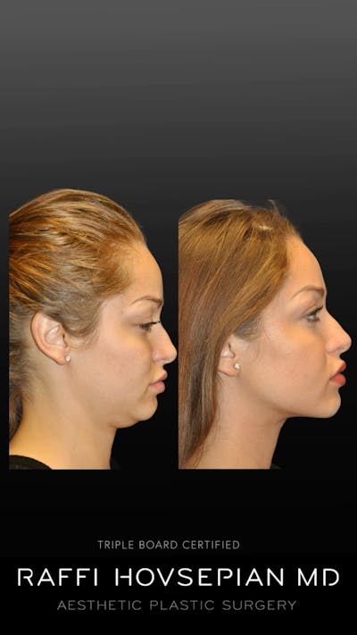 Procedures Before & After Gallery - Patient 189892903 - Image 1