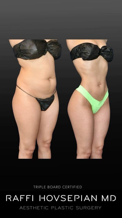 Procedures Before & After Gallery - Patient 275418 - Image 1