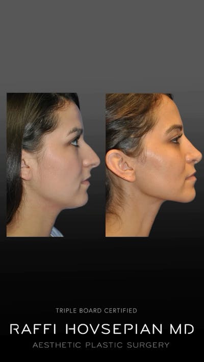 Procedures Before & After Gallery - Patient 226545 - Image 1
