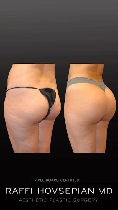 Procedures Before & After Gallery - Patient 394951 - Image 1
