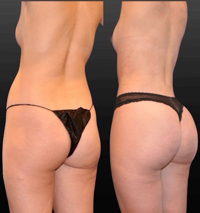 Procedures Before & After Gallery - Patient 220403 - Image 1