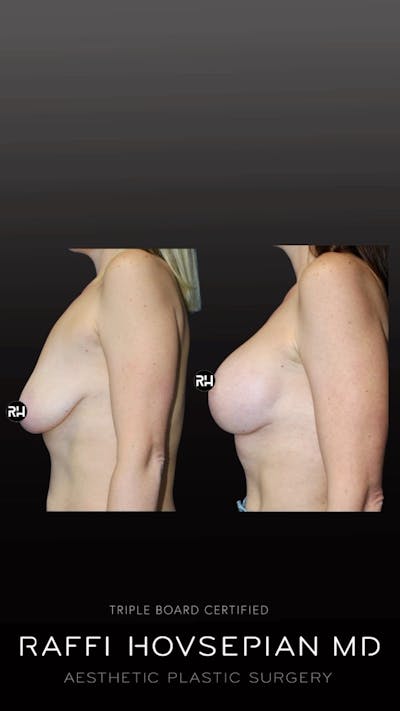 Procedures Before & After Gallery - Patient 277035 - Image 1