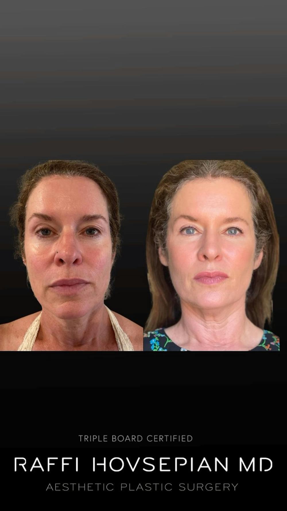 Procedures Before & After Gallery - Patient 171713 - Image 1