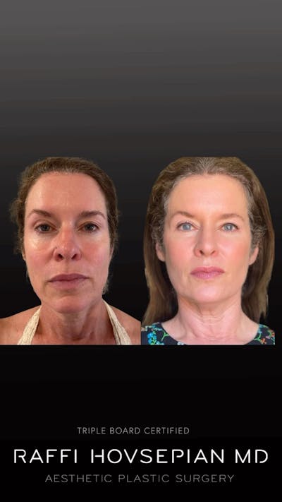 Procedures Before & After Gallery - Patient 171713 - Image 1