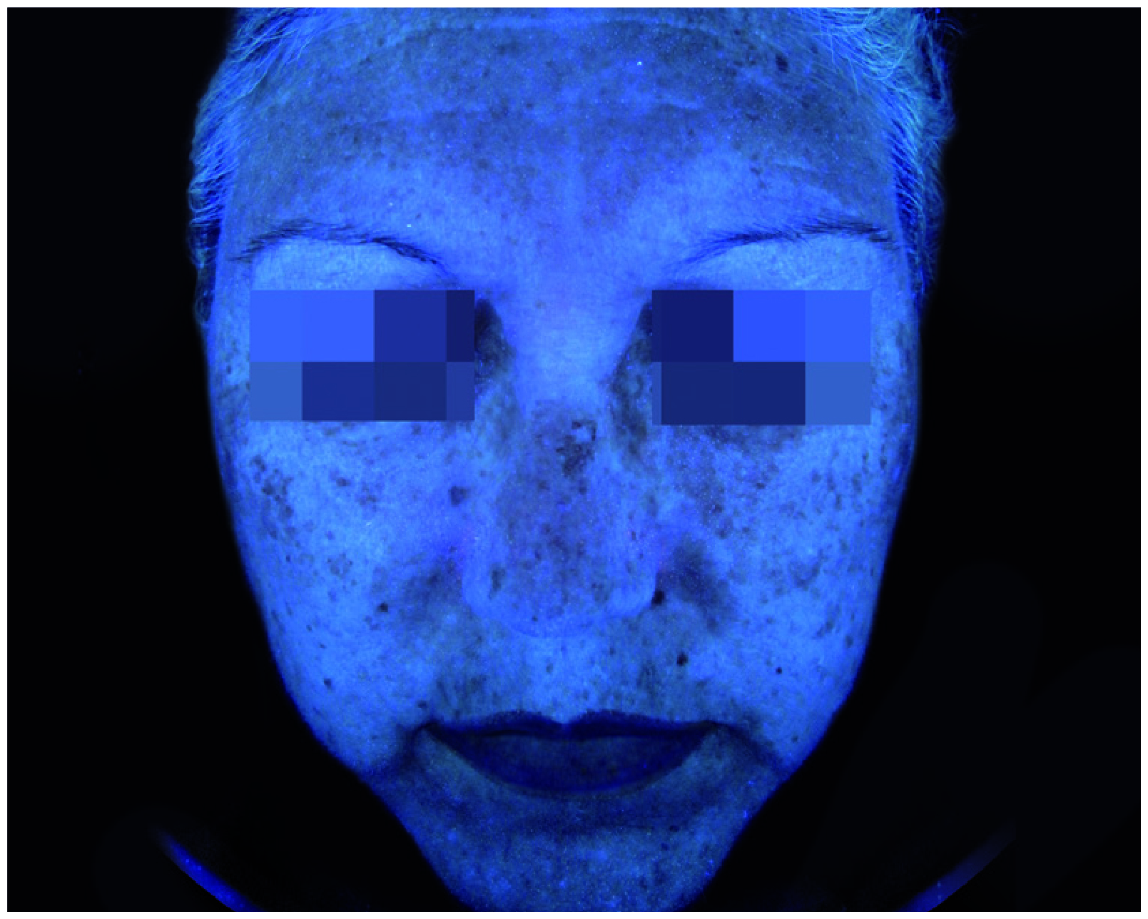 Mesopeel MD Melanostop Tranex Before 3