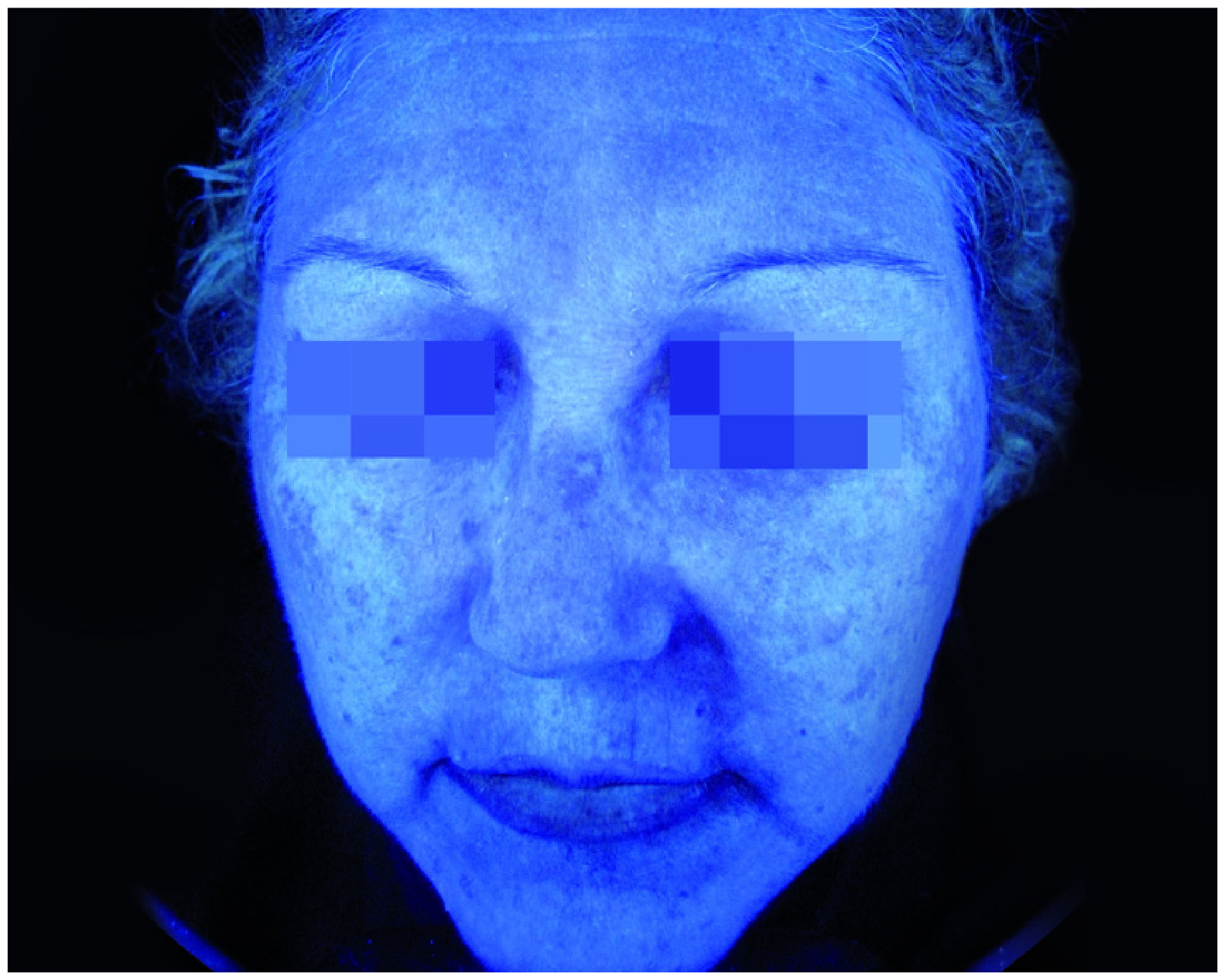 Mesopeel MD Melanostop Tranex Afters 3