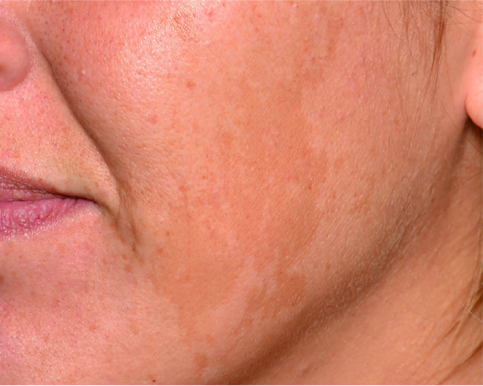 Mesopeel MD Melanostop Tranex Before 2