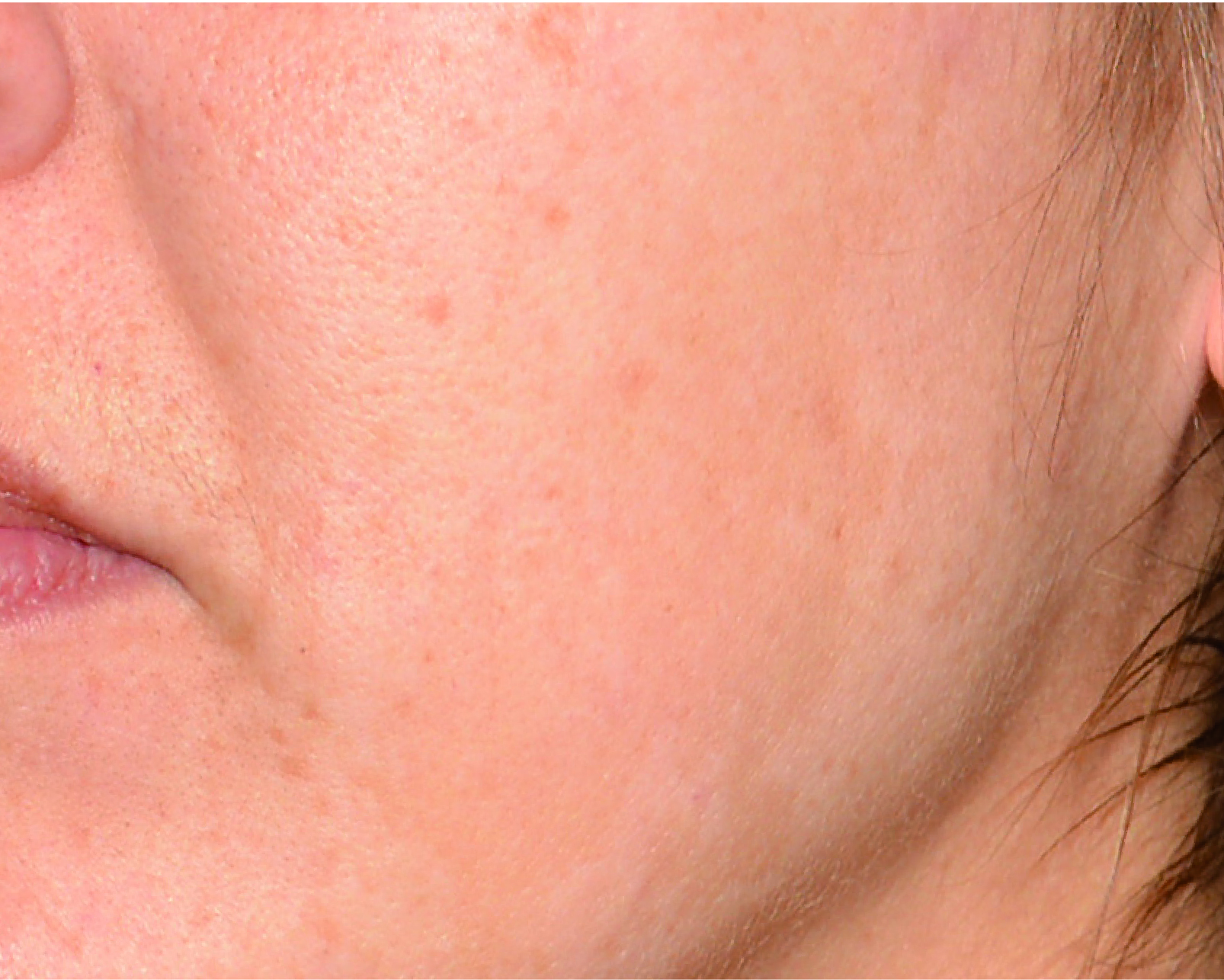 Mesopeel MD Melanostop Tranex After 2