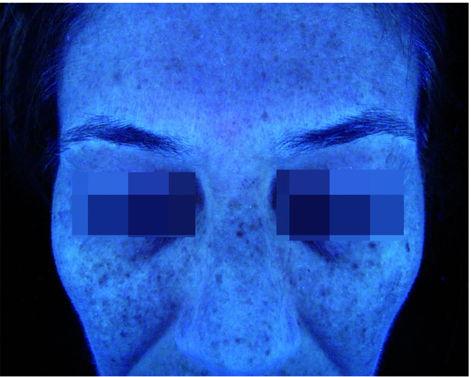 Mesopeel MD Melanostop Tranex Before 1