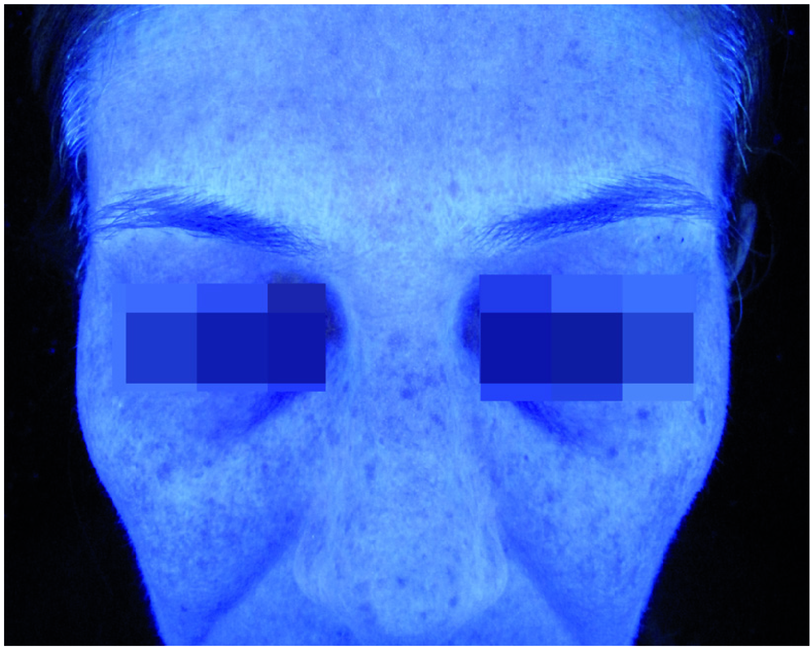 Mesopeel MD Melanostop Tranex After 1