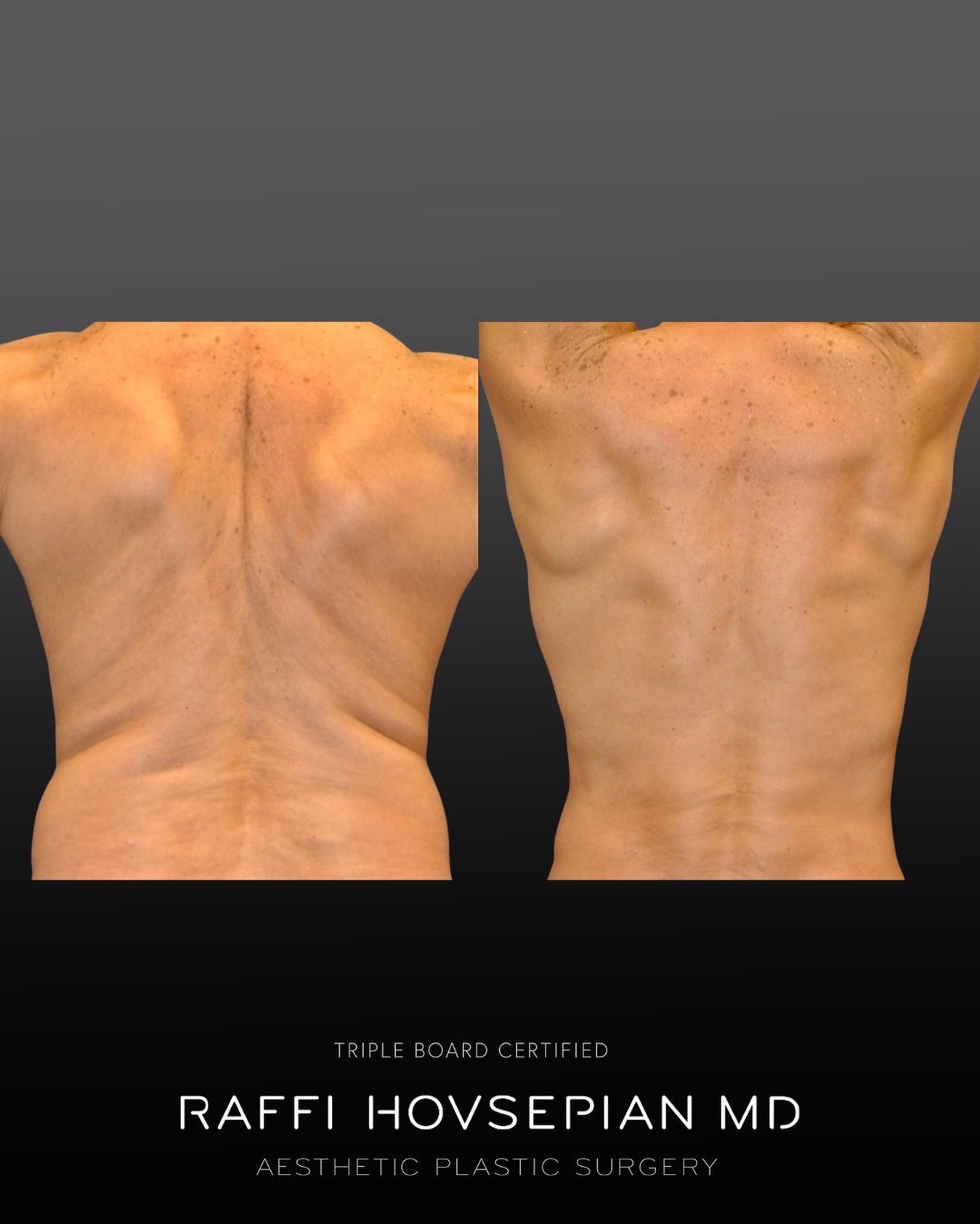 Dr. Hovsepian liposuction for men patient